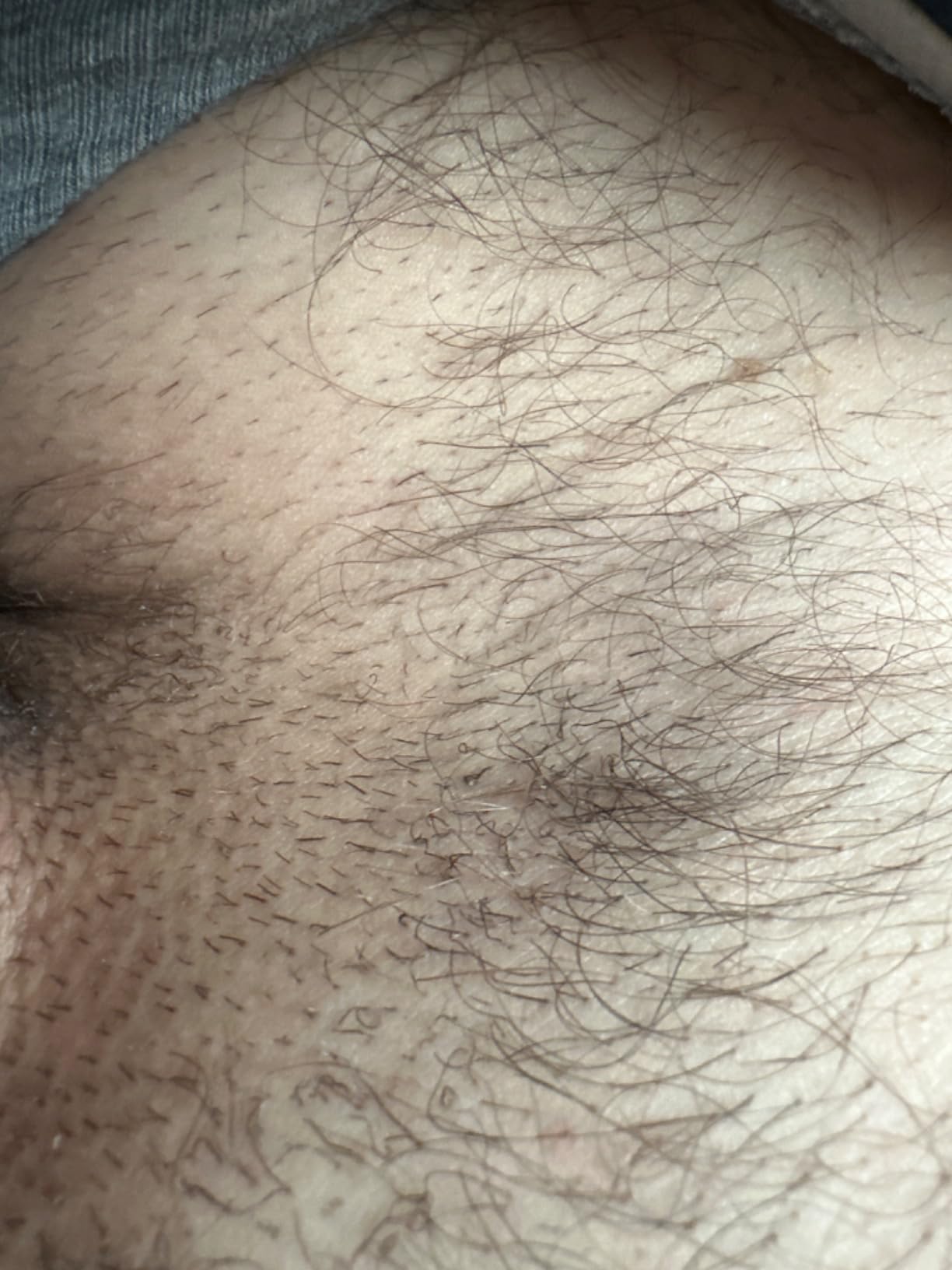 Braun Smart IPL Skin iExpert Pro 7 - VOGUE's Best Hair Removal Device, World's 1st Smart App, 3 Heads, IPL7243 customer photo 2