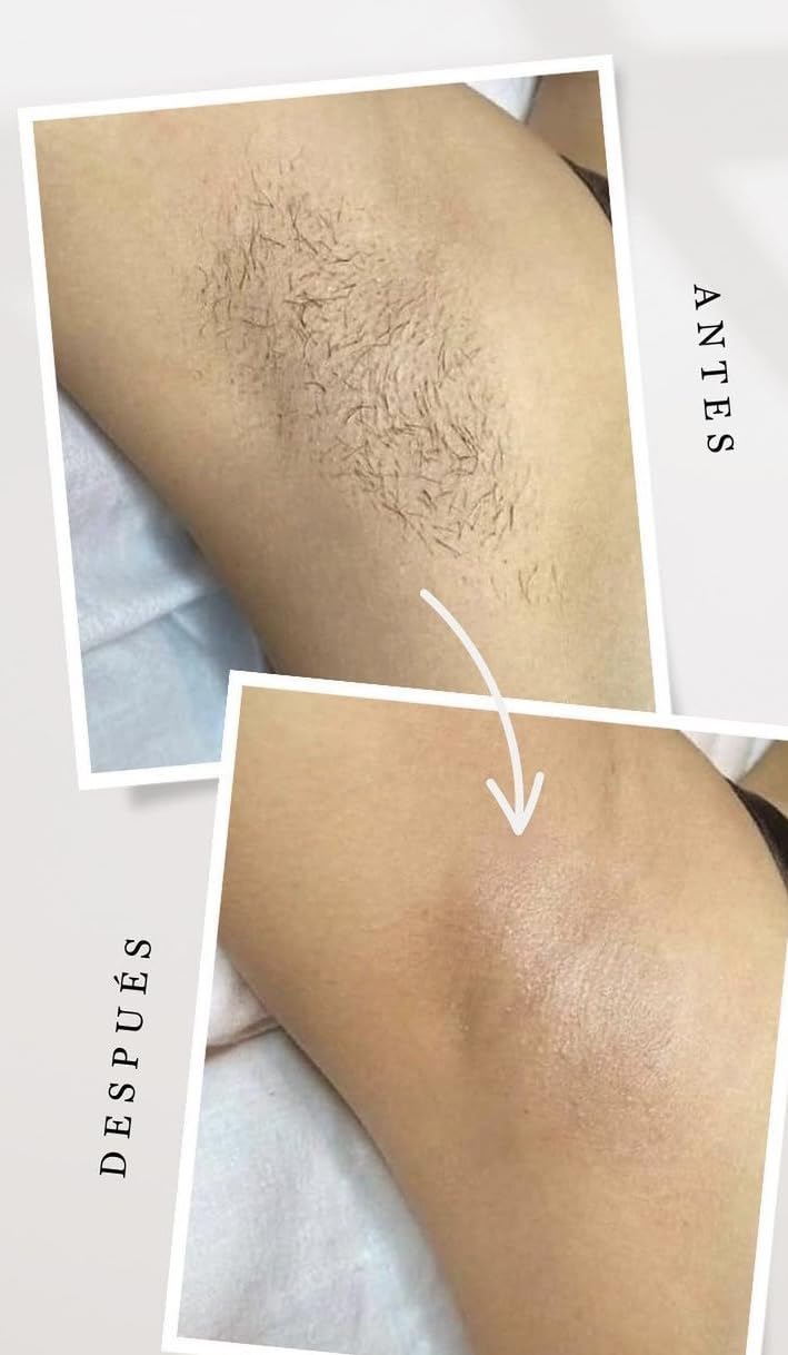 INIA HAUTE Pro Laser Hair Removal with Ice-Cooling Care for Women and Men - Painless At-Home IPL Hair Remover for Coarse Hair, Bikini & All Body Areas customer photo 1