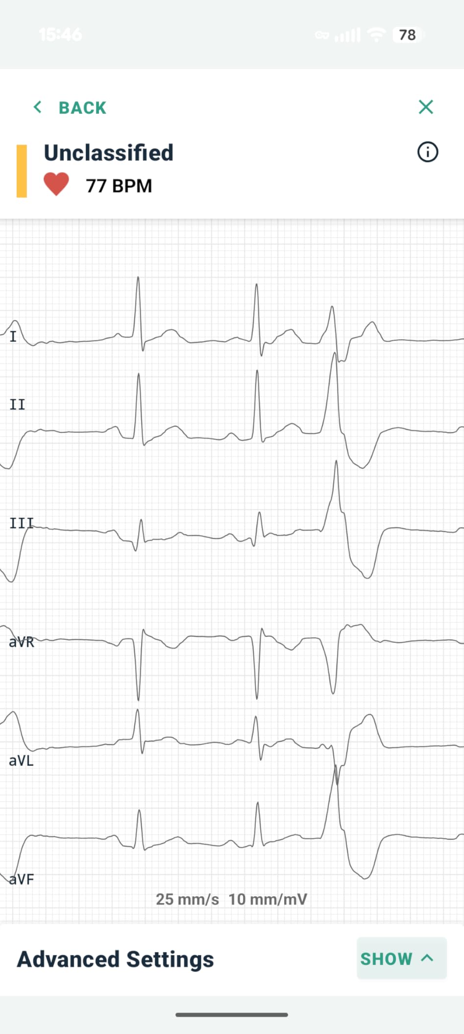 KardiaMobile 6-Lead Personal EKG Monitor – Six Views of The Heart – Detects AFib and Irregular Arrhythmias – Instant Results in 30 Seconds – Works with Most Smartphones - FSA/HSA Eligible customer photo 2